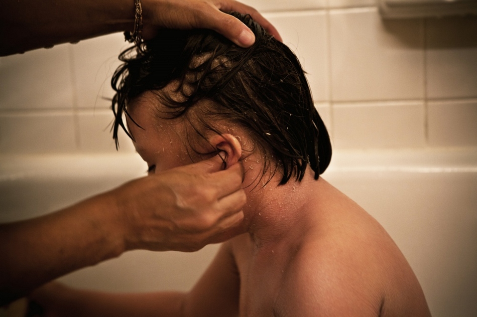 孤兒?。呼~鱗病女孩的艱難生活【圖】