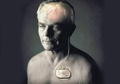 起搏器真的能治好帕金森病嗎？