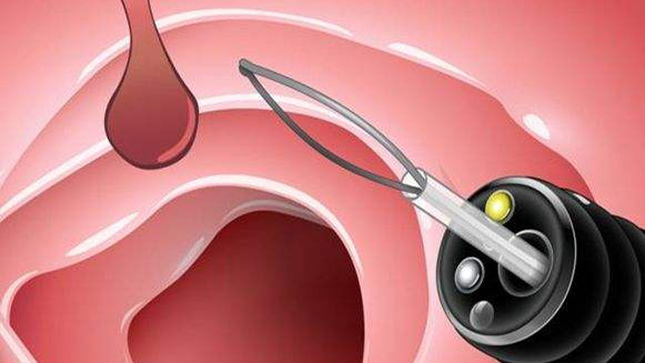 【健康解碼&middot;小貼士】檢查出息肉 需要切除嗎？